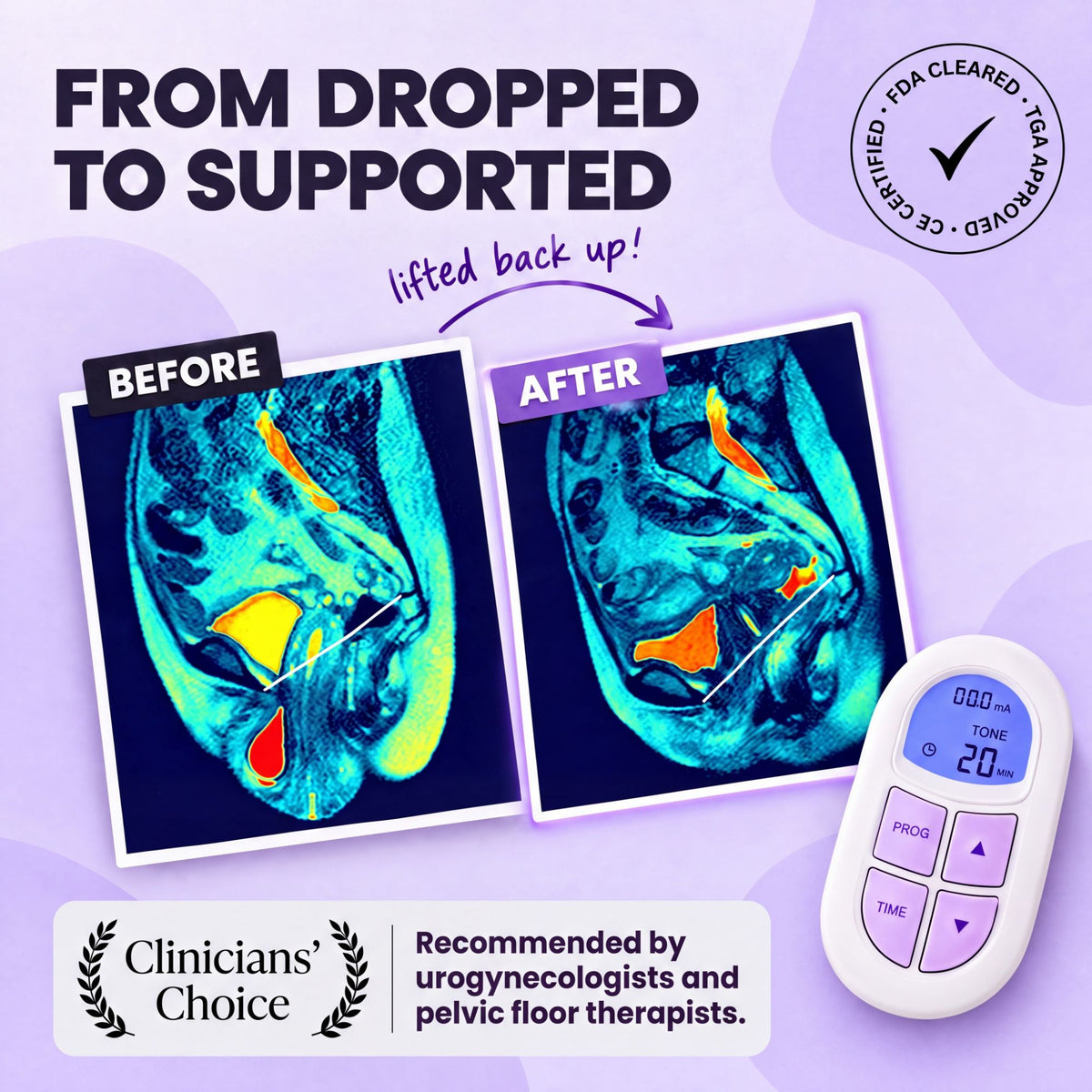 Prolapse MRI before and after - from dropped to supported